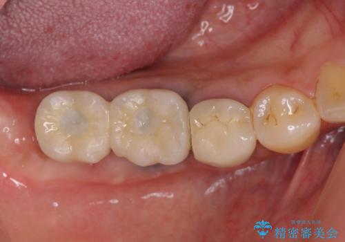 臼歯部インプラント治療の治療後