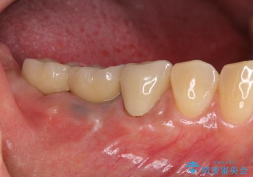 臼歯部インプラント治療の症例 治療後