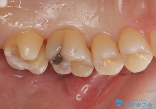 奥歯の虫歯 セラミックインレーによる治療の治療中