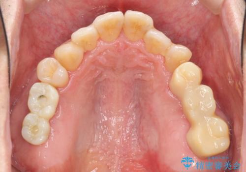 インプラント治療を併用した全顎歯周病治療の治療中