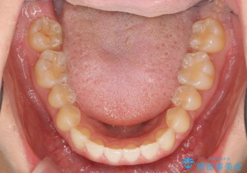 前歯のガタつきをきれいに　マウスピース矯正治療の治療後