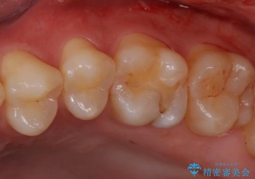 奥歯に隠れた虫歯　セラミックインレーでの修復の症例 治療前