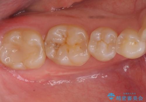 隠れているむし歯 セラミックインレーによる治療の症例 治療前