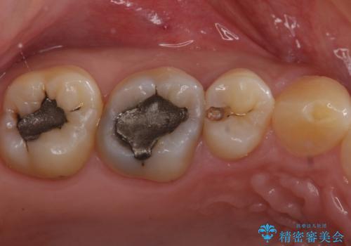 たまにしみる奥歯 セラミックインレーでの修復の治療中