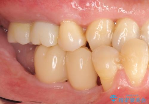 インプラント治療を併用した全顎歯周病治療の治療中