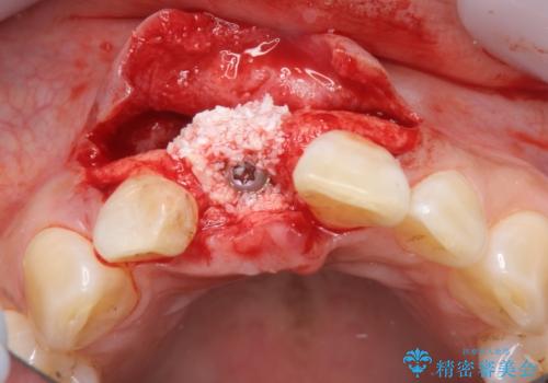 骨造成を伴う前歯のインプラント治療の治療中