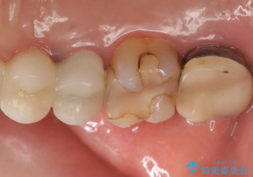 時々しみる奥歯 適合の悪いインレーからクラウンへのやり替えの治療前