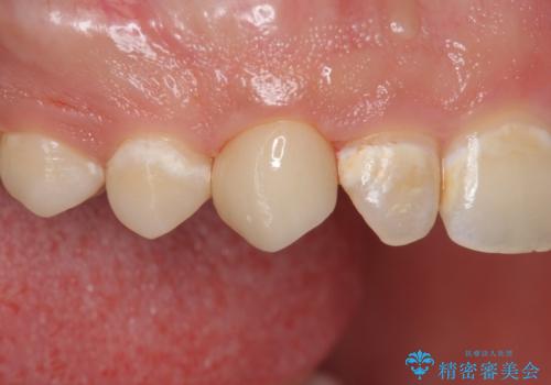 穴が開いた前歯 白いクラウンで修復の症例 治療後
