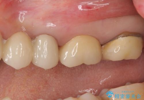 時々しみる奥歯 適合の悪いインレーからクラウンへのやり替えの治療後