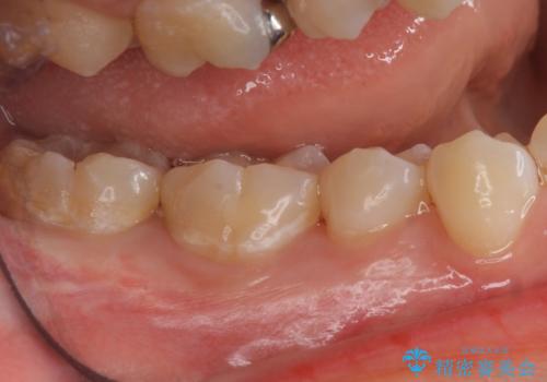 隠れているむし歯 セラミックインレーによる治療の治療後