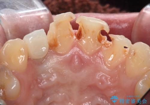前歯の虫歯 オールセラミック治療の治療中