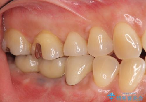 臼歯部インプラント治療の治療後