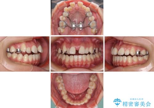 急速拡大装置 狭い上顎骨を拡大してワイヤー装置で短期間治療の治療中