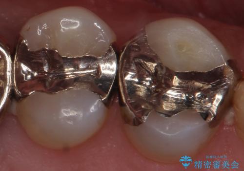 外から見える銀歯 セラミックでのやり替えの治療前