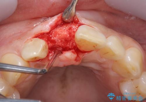 骨造成を伴う前歯のインプラント治療の治療中