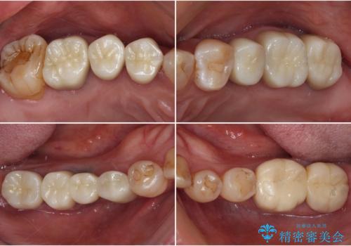 治療後に歯茎から出血 インプラントとオールセラミッククラウンの補綴治療の症例 治療後