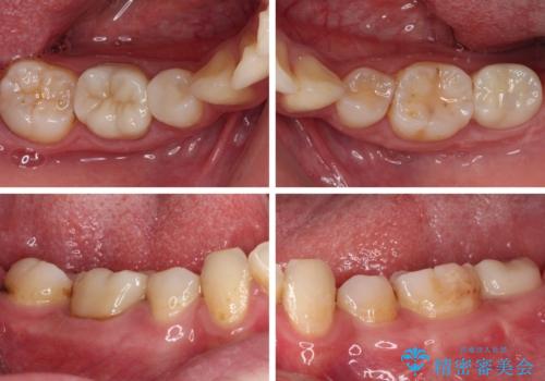 部分矯正を併用した奥歯のインプラント治療の治療後