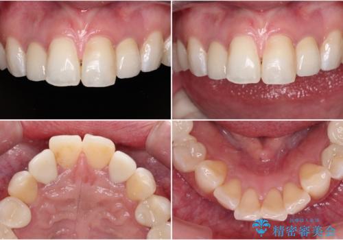 金属の見えてしまったクラウン セラミッククラウンで自然にの治療後
