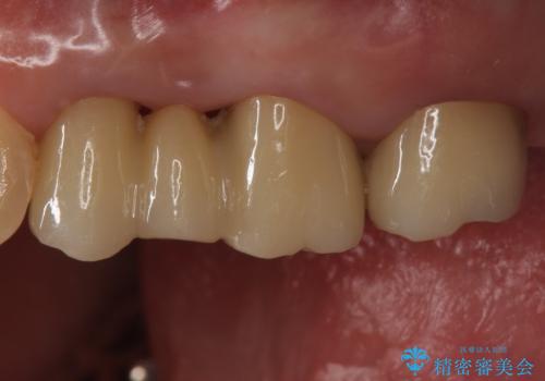 銀歯を白くしたい セラミックブリッジでの治療の治療後