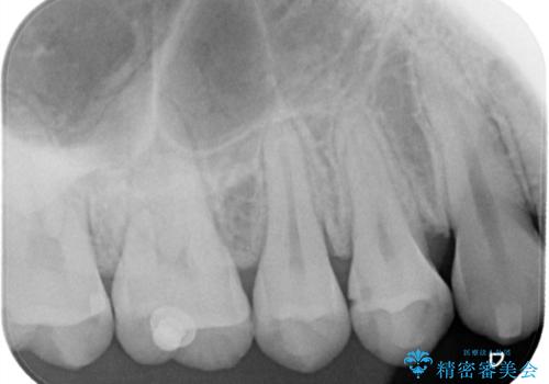 【セラミックインレー】歯と歯の間の虫歯治療の治療前