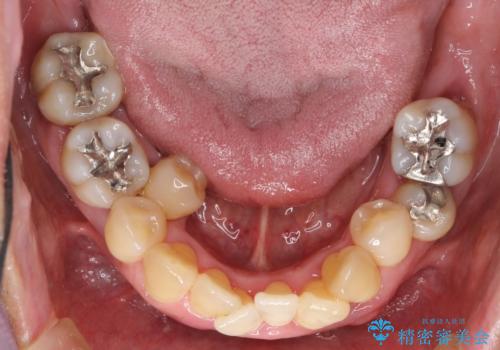 インプラント治療を併用した全顎歯周病治療の治療前