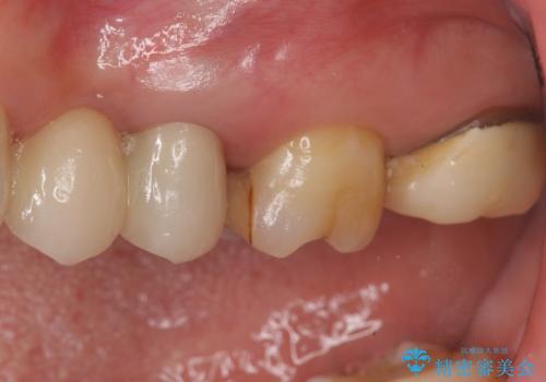 時々しみる奥歯 適合の悪いインレーからクラウンへのやり替えの治療前