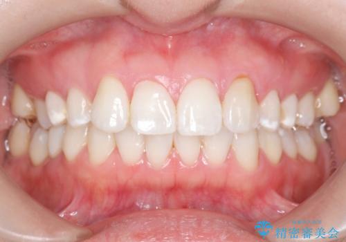 初めてのオフィスホワイトニングの治療後