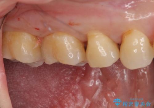 奥歯の虫歯 セラミックインレーによる治療の治療前