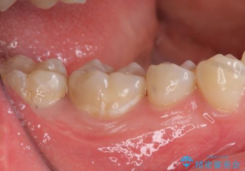 隠れているむし歯 セラミックインレーによる治療の治療前