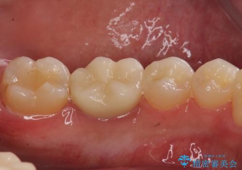 銀歯のやり替え セラミックで白い歯にの治療後