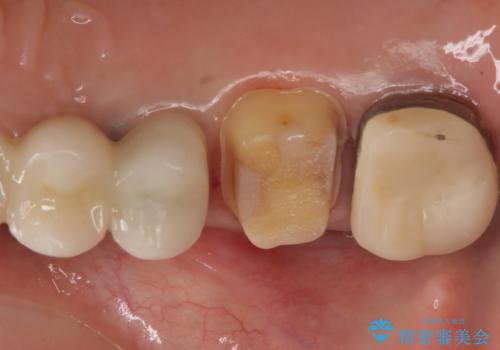 時々しみる奥歯 適合の悪いインレーからクラウンへのやり替えの治療中