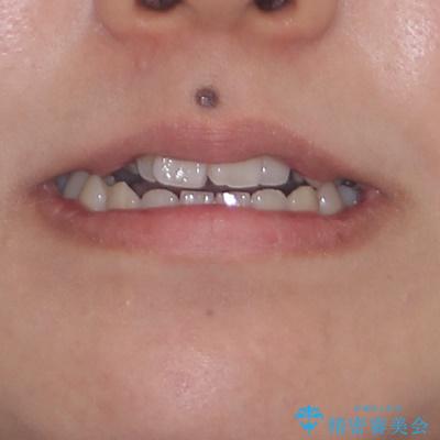 急速拡大装置　狭い上顎骨を拡大してワイヤー装置で短期間治療の治療前（顔貌）