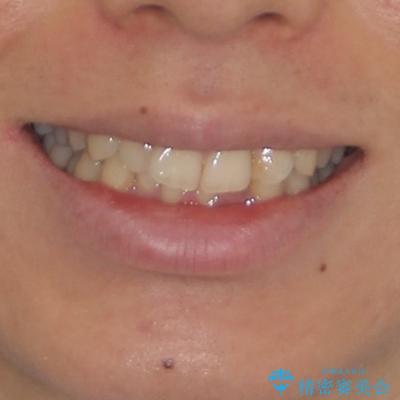 前歯のデコボコをスッキリ改善　インビザライン矯正の治療前（顔貌）