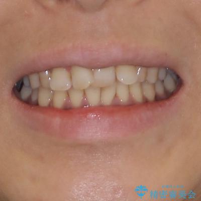 インビザラインでのんびりと矯正治療 の治療前(顔貌)