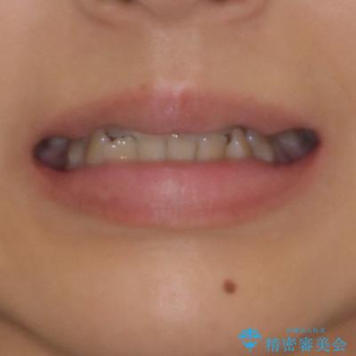八重歯とクロスバイト　目立たないワイヤー装置での抜歯矯正の治療前（顔貌）