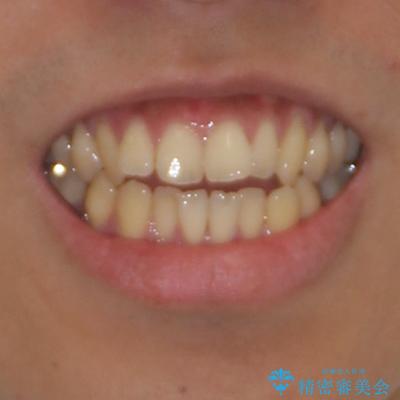 隙間が空いて突出した前歯を治した　ワイヤー装置による抜歯矯正の治療前（顔貌）