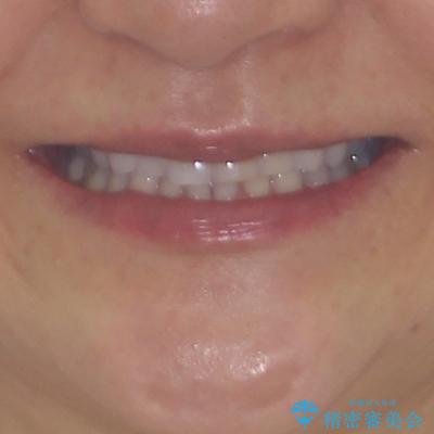 矯正治療の後戻り インビザライン・ライトでの再矯正の治療前(顔貌)