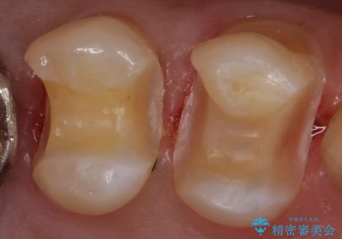 外から見える銀歯 セラミックでのやり替えの治療中