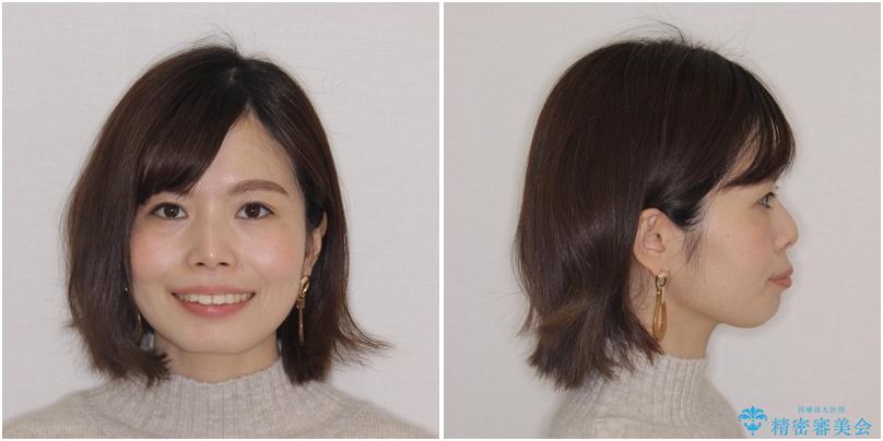 【モニター】口が閉じにくい 目立たないワイヤー装置で口元を引っ込めるの治療前(顔貌)
