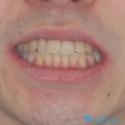 前歯のデコボコを治したい ワイヤー装置でお手軽に矯正治療の治療前(顔貌)