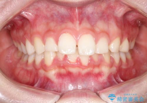 【インビザライン】出っ歯を引っ込めたい。の症例 治療前