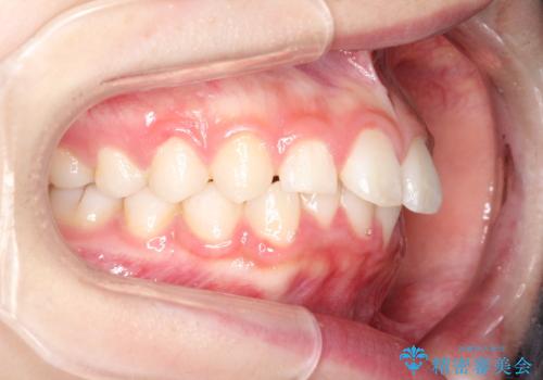 【インビザライン】出っ歯を引っ込めたい。の治療前