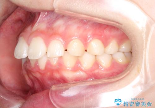 【インビザライン】出っ歯を引っ込めたい。の治療前