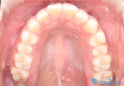 【インビザライン】出っ歯を引っ込めたい。の治療前