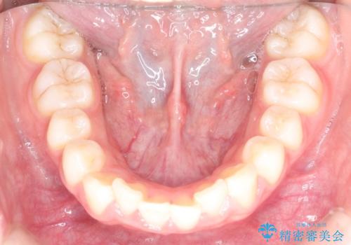 【インビザライン】出っ歯を引っ込めたい。の治療前