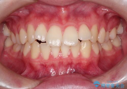 【インビザライン】前歯のガタガタをなおしたいの症例 治療前