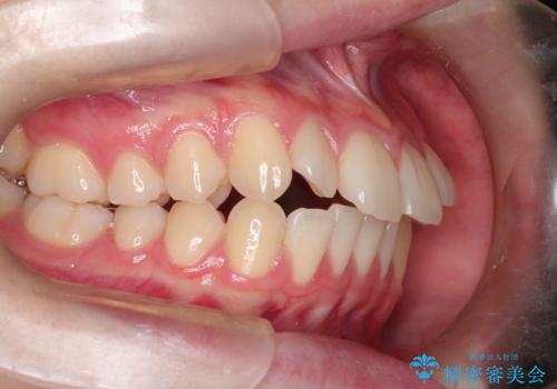 【インビザライン】前歯のガタガタをなおしたいの治療前