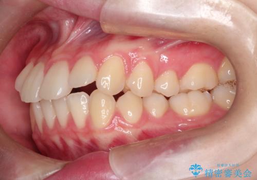 【インビザライン】前歯のガタガタをなおしたいの治療前