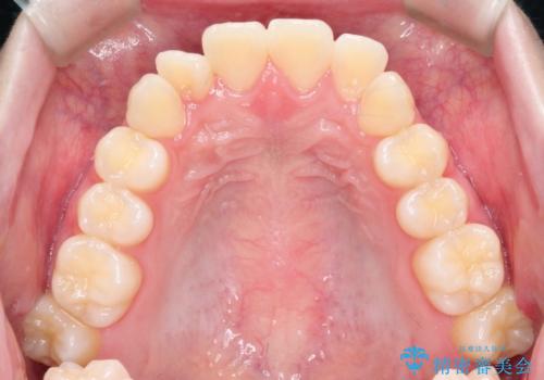 【インビザライン】前歯のガタガタをなおしたいの治療前