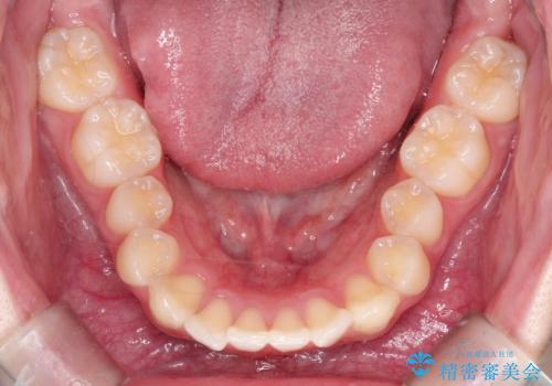 【インビザライン】前歯のガタガタをなおしたいの治療前